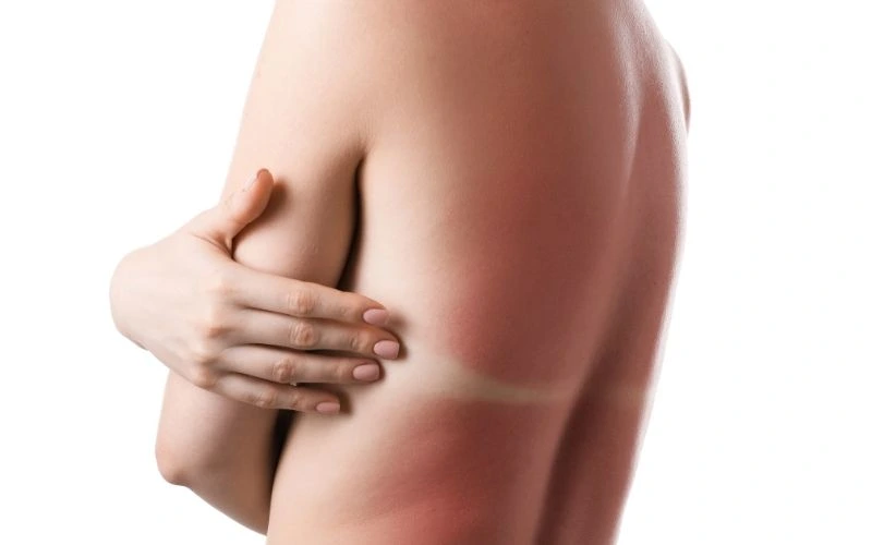 impact du soleil sur la peau