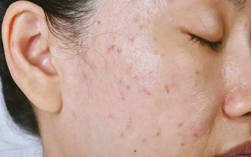 dysbiose et peau grasse