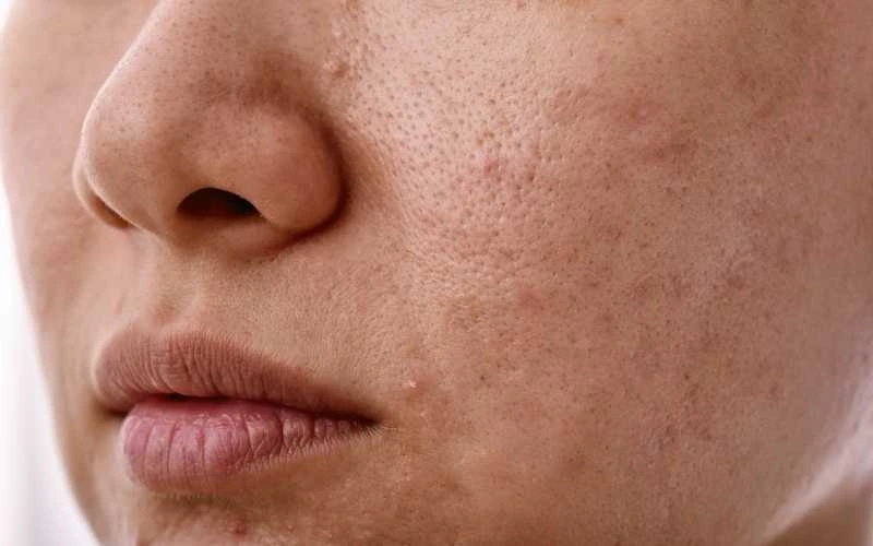 microbiote peau grasse