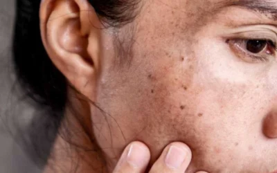 Peau sèche et peau déshydratée : restaurer la barrière cutanée et l’hydratation grâce au microbiote