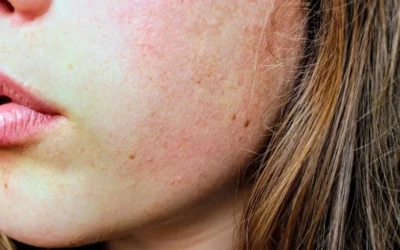 Microbiote et peau sensible : comprendre l’inflammation cutanée et restaurer la tolérance naturellement