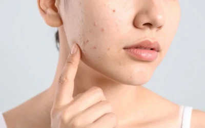 Pourquoi les imperfections apparaissent-elles après les vacances ?