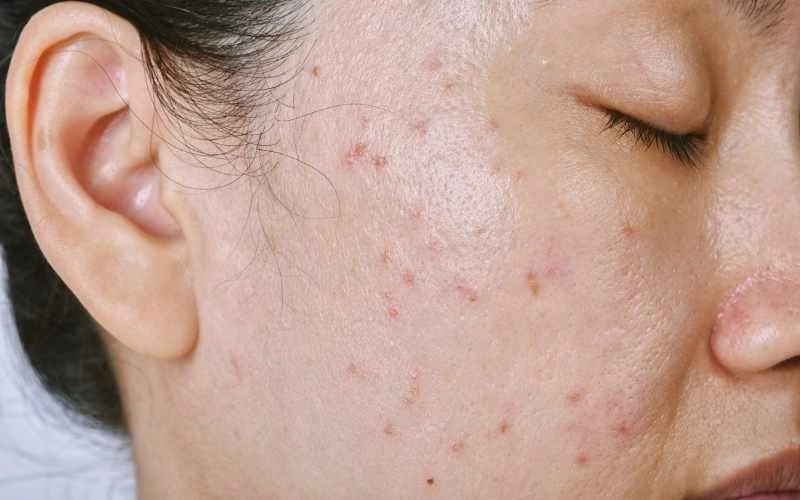 boutons sur visage, effet rebond