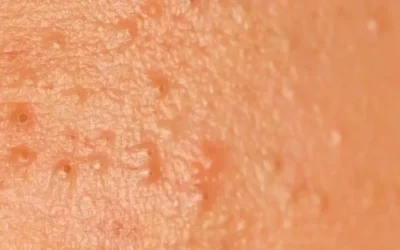 Effet rebond à la rentrée : pourquoi votre peau se dérègle après l’été ?