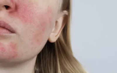 Rosacée et peau sensible : comment prendre soin d’une peau qui rougit facilement ?