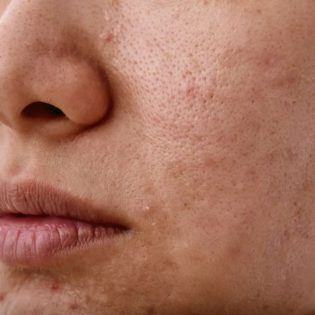 Gros plan sur la zone du nez et de la bouche d'une personne présentant des signes de sécheresse cutanée et de déshydratation
