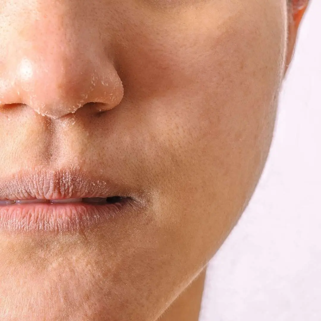 Gros plan sur la zone du nez et de la bouche d'une personne présentant des signes de sécheresse cutanée et de déshydratation