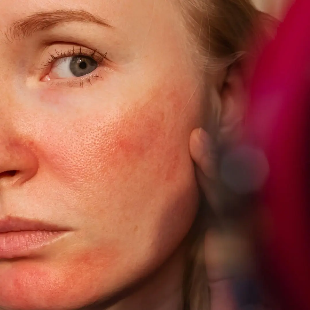 Gros plan sur la zone du nez et de la bouche d'une personne présentant des signes de sécheresse cutanée et de déshydratation