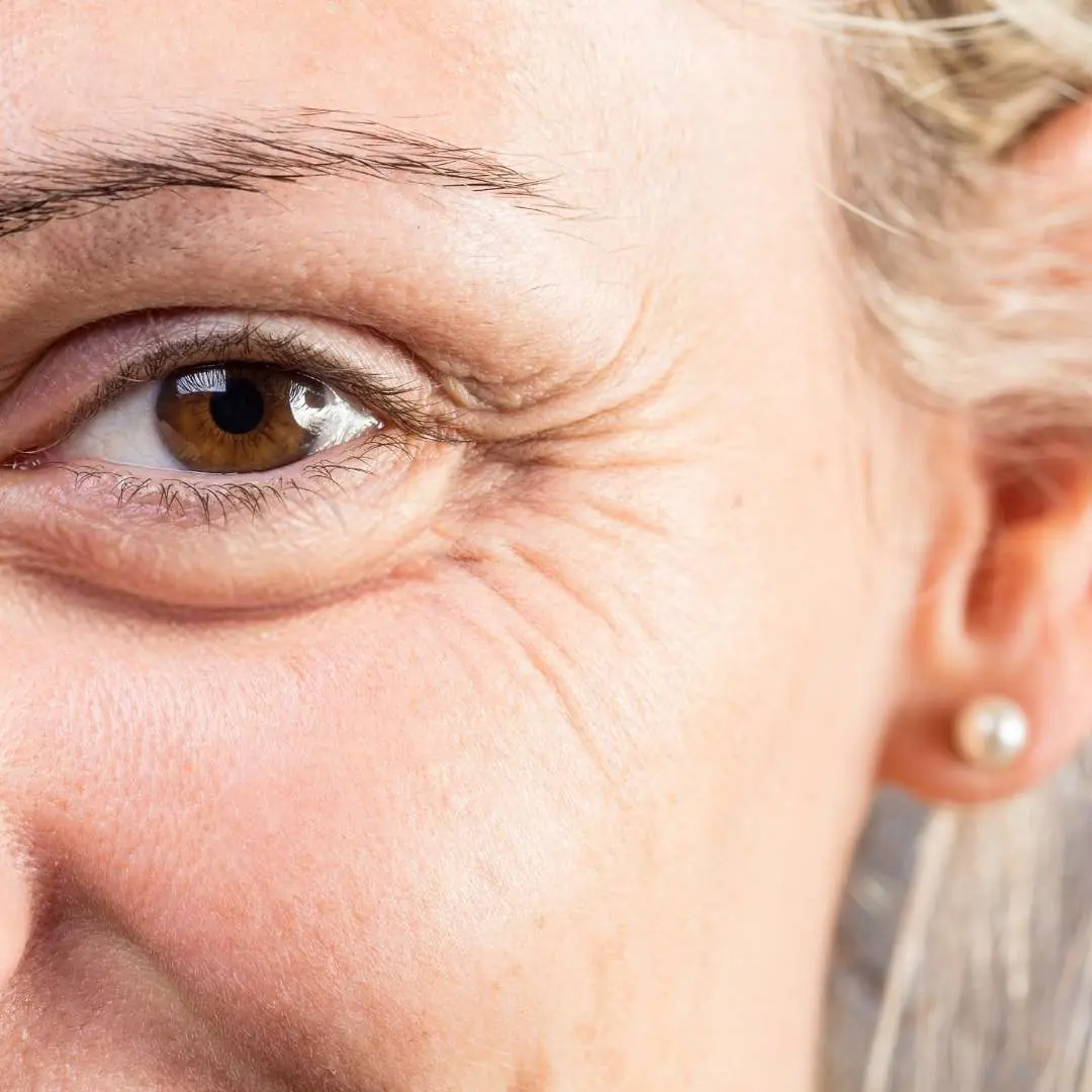 Gros plan sur la zone du nez et de la bouche d'une personne présentant des signes de sécheresse cutanée et de déshydratation